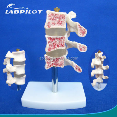 Advanced PVC Educational Models Cutaway Osteoporosis of Spine Lesions of Lumbar Vertebra