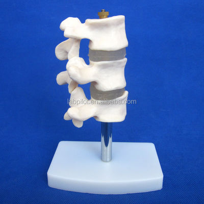 Advanced PVC Educational Models Cutaway Osteoporosis of Spine Lesions of Lumbar Vertebra