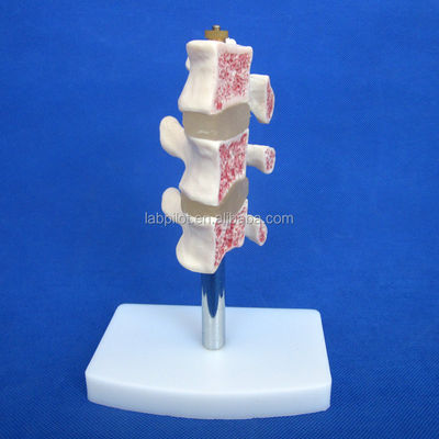 Advanced PVC Educational Models Cutaway Osteoporosis of Spine Lesions of Lumbar Vertebra