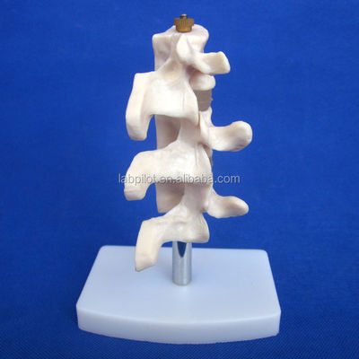 Advanced PVC Educational Models Cutaway Osteoporosis of Spine Lesions of Lumbar Vertebra