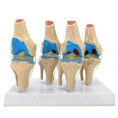 Anatomical demonstration of Human Knee Joint Pathology Model for Medical Science