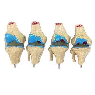 Anatomical demonstration of Human Knee Joint Pathology Model for Medical Science