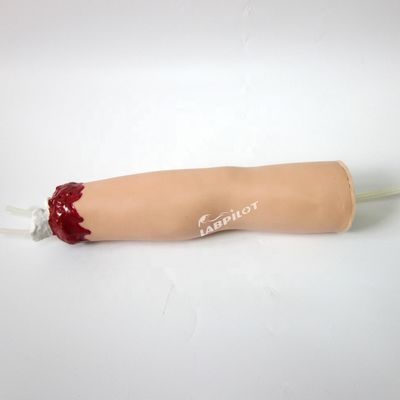 Trauma Nursing Care Model Arm Amputation and Hemostasis for Upper Limb Wound Treatment