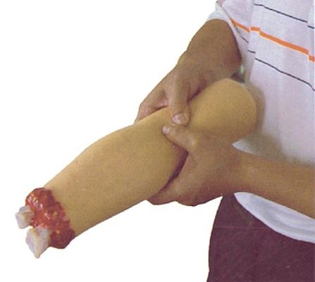 Trauma Nursing Care Model Arm Amputation and Hemostasis for Upper Limb Wound Treatment