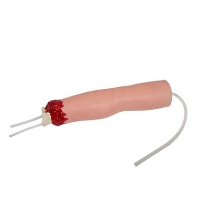 Trauma Nursing Care Model Arm Amputation and Hemostasis for Upper Limb Wound Treatment