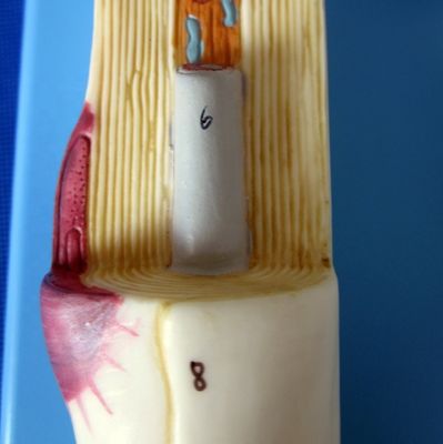 Advanced PVC Anatomical Model of Enlarged Neuronal Cell Body and Nerve Fiber Structure