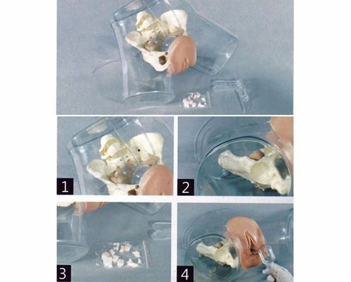 Obstetrics-Gynecology Model Transparent Uterine Curettage Simulator for Nurse School