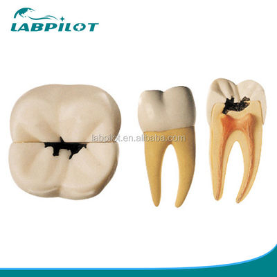 Anatomical Model 16 Times Amplified Dental Caries Model for Education and Teaching