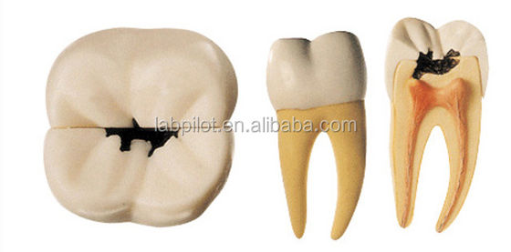 Anatomical Model 16 Times Amplified Dental Caries Model for Education and Teaching