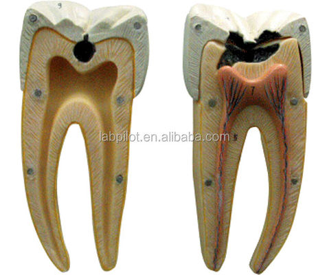 Anatomical Model 16 Times Amplified Dental Caries Model for Education and Teaching