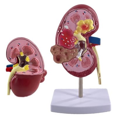 PVC Pathological Kidney Model for Medical Schools and Urology Hospitals Demonstration