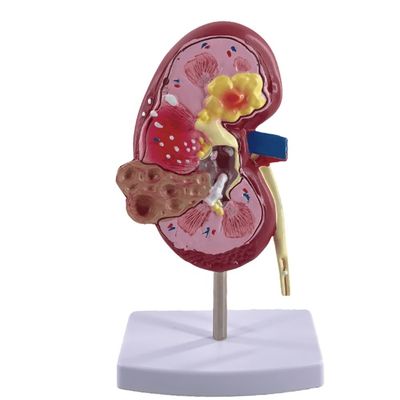 PVC Pathological Kidney Model for Medical Schools and Urology Hospitals Demonstration
