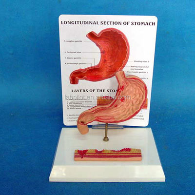 Advanced PVC Educational Model for Human Stomach Ulcer Gastric Ulcer Representation