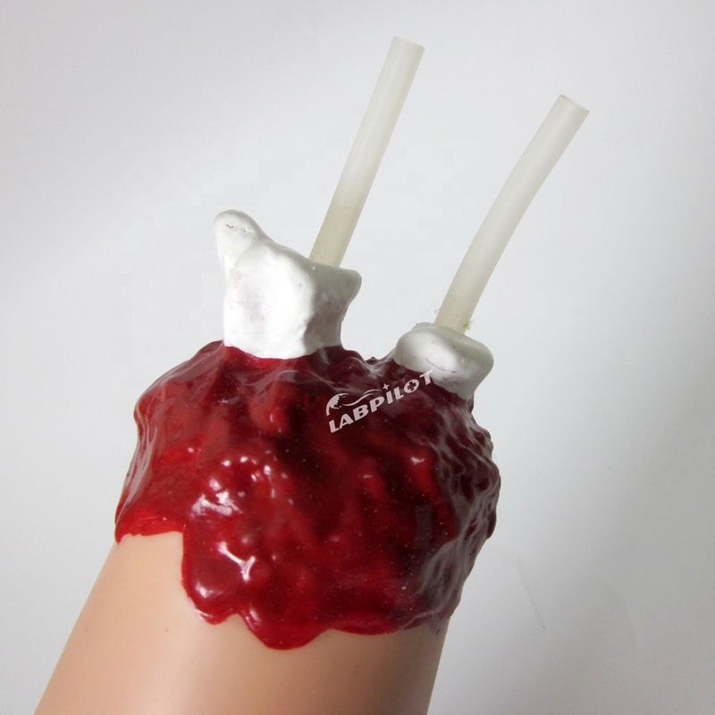 Trauma Nursing Care Model Arm Amputation and Hemostasis for Upper Limb Wound Treatment